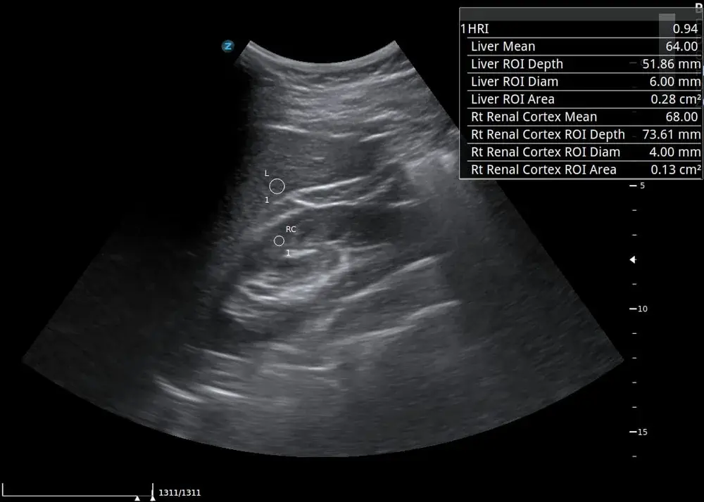 Hepatorenal indeks